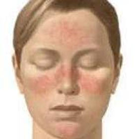 Gebelikte cilt lekeleri ve çatlakları