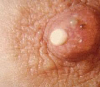 Memeden süt gelmesi