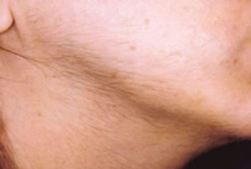 Kadınlarda tüylenme artışı