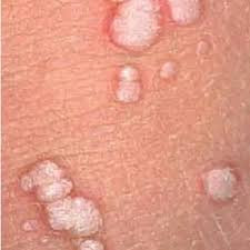 HPV Genital Siğil Nedir? Belirtileri, Bulaşma Yolları ve Tedavi Yöntemleri- Prof.Dr.Birol Vural