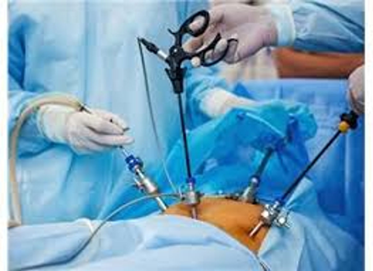 Laparoskopik Miyom Ameliyatı