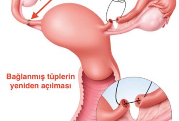 Laparoskopik Tüplerin Açılması