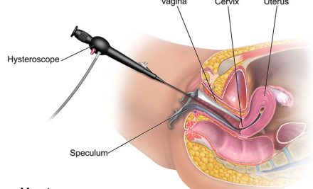 Histeroskopik Polip Ameliyatı Nedir
