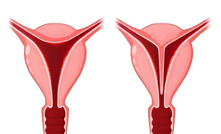 Histeroskopik Septum