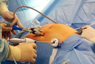 Laparoskopik Yumurtalık Kisti