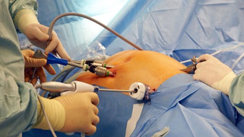 Çikolata Kisti Ameliyatı ve Endometriozis Cerrahisi