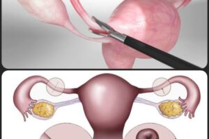 Laparoskopik Tüp Ligasyonu