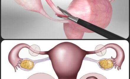 Laparoskopik Tüp Ligasyonu