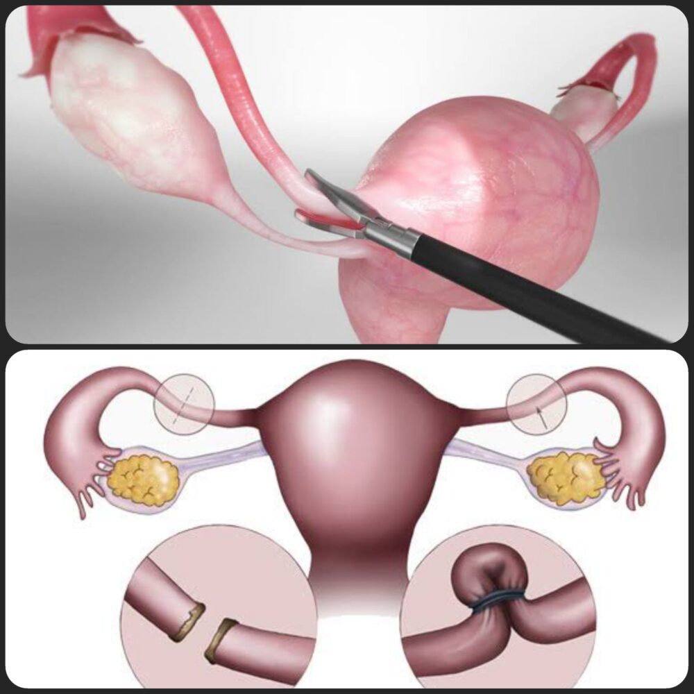 Laparoskopik Tüp Ligasyonu